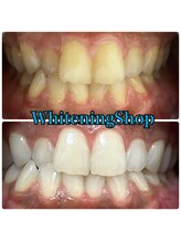 ホワイトニングショップ 山形店(Whiteningshop)/タバコを吸ってもOK