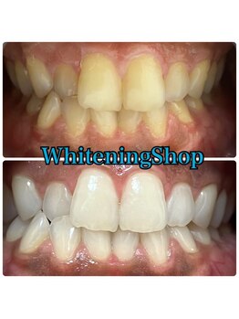 ホワイトニングショップ 山形店(Whiteningshop)/タバコを吸ってもOK