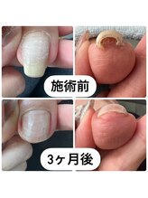 エスネイル(S Nail)/巻き爪ケア/巻き爪補正