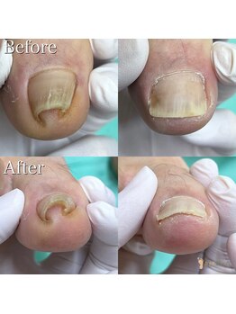 巻き爪補正店 久留米店/巻き爪