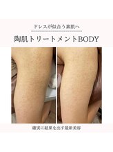 イルソーレ(IL Sole)/ざらつきもハーブピーリングで