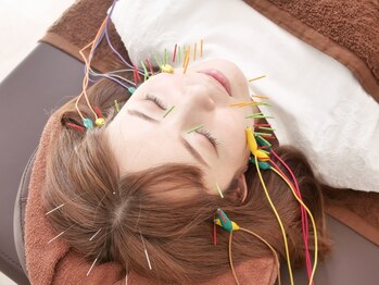 ダズル(DAZZLE)の写真/《結果重視!美容鍼で小顔に☆》カウンセリングで”あなただけの施術メニュー”をご提案◎肌質の改善も◎