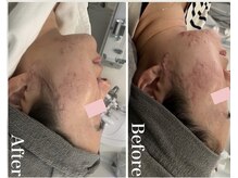 ルビー(Ruby)/【20代】ニキビ悩み・1回