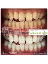 ホワイトニングサロン 広島店/【ホワイトニング施術例】
