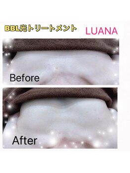 ルアナ(Luana)/BBL光バストトリートメント!