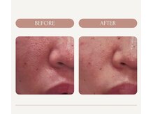 マオ(mao)/毛穴洗浄ハイドロピーリング