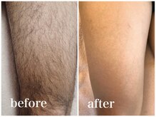 メンズサバス たまプラーザ/メンズ足脱毛/5回