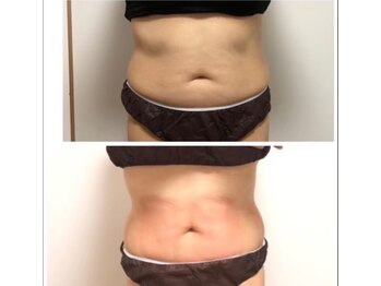 フラットベリー 恵比寿(Flat BELLY)/脂肪冷却2カップ