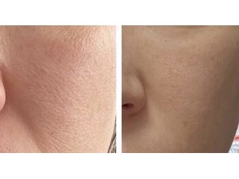 サロン ラズリ 久留米店(SALON Lazuli)/【イオン導入】EGFで表皮生成◎