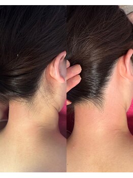 キエズ(KIES)/もみあげワックス脱毛