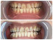 コントレール 歯ぁと(CONTRAIL)/あきらめていた70歳の喜び