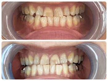 コントレール 歯ぁと(CONTRAIL)/あきらめていた70歳の喜び