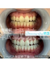 ホワイトニングサロン 名古屋 栄店/【ホワイトニング】