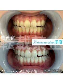 ホワイトニングサロン 名古屋 栄店/【ホワイトニング】