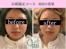 キュープ 福岡大牟田店(Qpu)/小顔矯正4回コースの変化