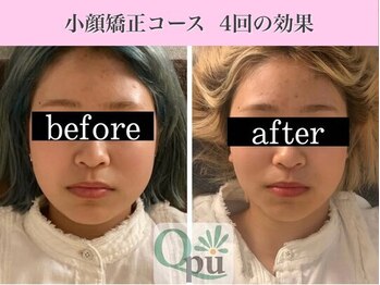 キュープ 福岡大牟田店(Qpu)/小顔矯正4回コースの変化