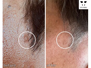 ルミラポー(Lumira Peau)/30代8回