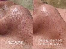 ハク 銀座(HAK.)/毛穴洗浄(小鼻ケア)Before/After