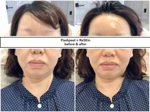 ディアメ(Diame)/サロンケアの威力!!