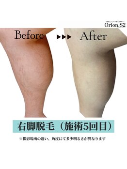 オリオンドットエスツー(Orion.S2)/【Before→After】