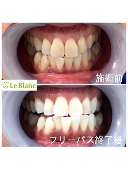 ルブラン 奈良店(Le Blanc)/ホワイトニングのタイミングは？
