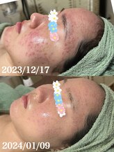 ルーチェ(LUCE)/グリーンピール スペシャル1DAY