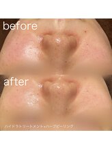 ルルラ リコ(lulula rico)/症例写真/ハーブピーリング