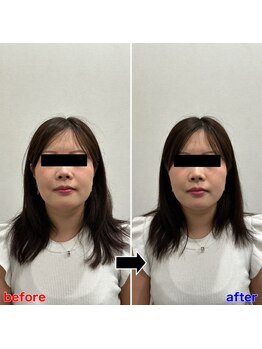 フロー鍼灸整体院(FLOW鍼灸整体院)/美容鍼 ビフォーアフター