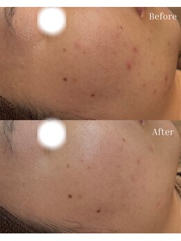 ベリスユイット(BELLIS HUIT)/【剥離なしハーブピーリング】