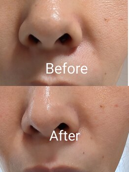 リリー(lily)/セラピール1回