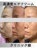 【お顔の筋トレ＆エクソソーム導入】通常￥36000→￥28000 160分
