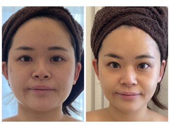 レイア 中城店(RayA)/戻らない小顔コルギ