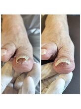 立川巻爪補正院/巻き爪　初回の術前・術後