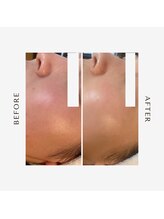 サンハート(SUN HEART)/ハリツヤUP！人気NO.1フォト美顔