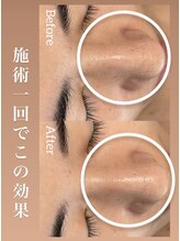 ルシェビューテイー(Luche Beauty)/毛穴撃退コース