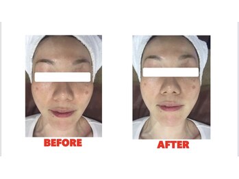 ラキ(Laki)/Eライトフェイシャル1回