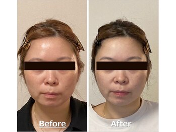 小顔22 ボルティ 赤坂支店(Bolty)/小顔シンメトリー矯正＆全身矯正