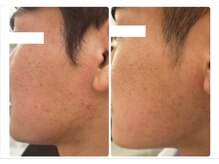 ホワイトアクア 池袋店(WHITE AQUA)/ハーブピーリング/毛穴洗浄/池袋