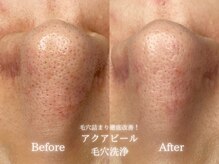 リル 和歌山市店(lilou)の雰囲気（毛穴詰まり・ざらつきにはアクアピールで徹底改善！）