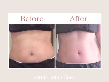 トータルビューティー ゆみえエステ(Total Beauty)/痩身/マグシェイプ ウエスト