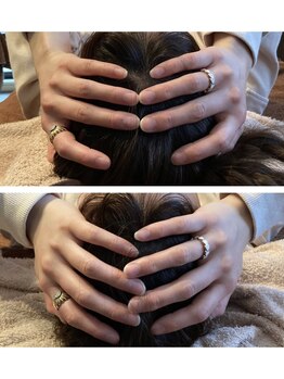 シャルム(CHARMEB)/頭まで小さくする美容鍼