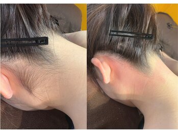 ピヴァーチェ(Pivace)/シュガーリング脱毛始めました♪