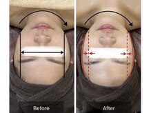 リリーガーデン 手稲店(Lily Garden)/ビフォーアフター　小顔/むくみ