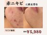 【ニキビでお悩みの方】鎮静イオンピーリング＆W鎮静パック