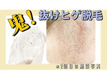 トレテル/鬼！抜けヒゲ脱毛