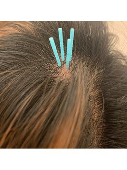 はしもと鍼灸整骨院/頭髪改善鍼