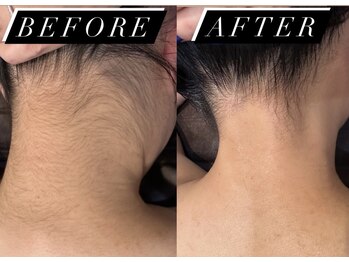 ヴィアス(vias)/うなじ脱毛