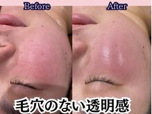 シオン 高崎(S'ion)/【ヒト幹細胞フェイシャル】