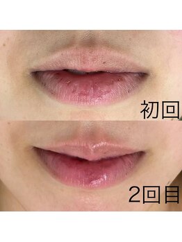 サロンドジェシカ(salon de Jessica)/プラズマ  唇ケア
