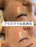 SNSで話題のプラズマシャワー！肌改善！　¥8000